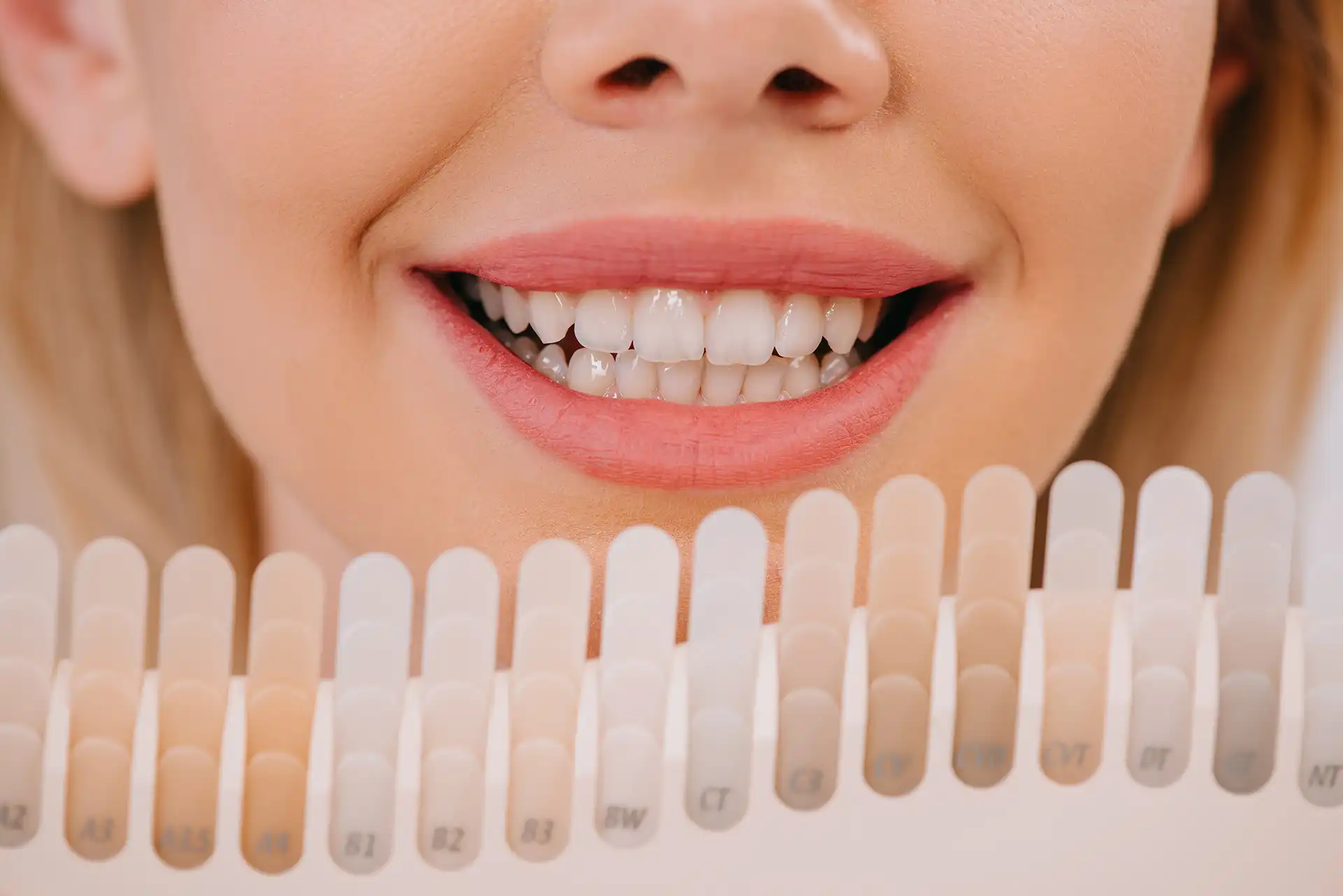 Veneers vs composite bonding : Is composite bonding better than veneers?