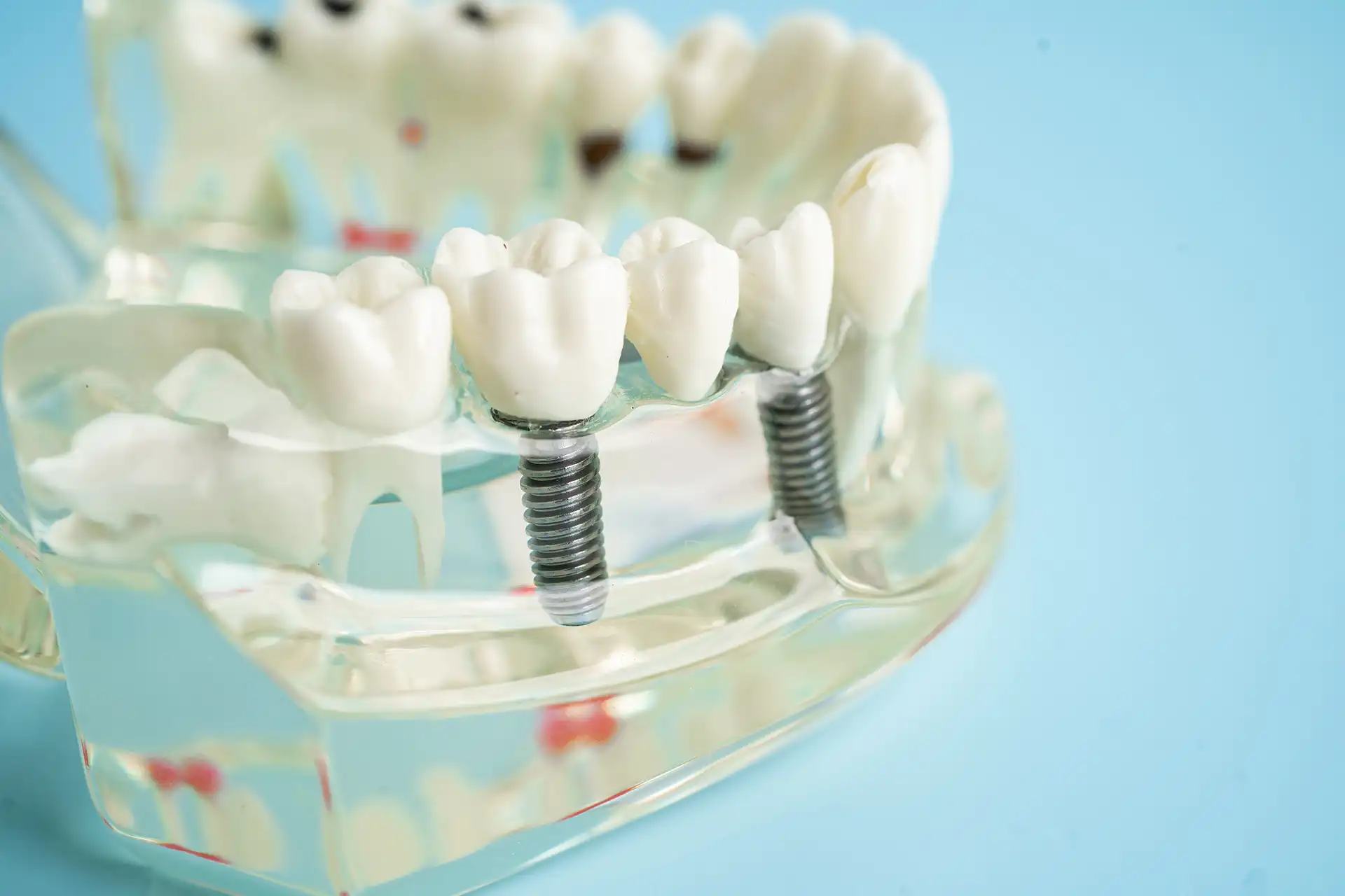 All on 6 dental implants in Turkey : Benefits, recovery and cost