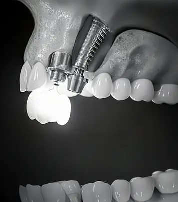 Dental Implants vs. Bridges: Which One Is Right for You?