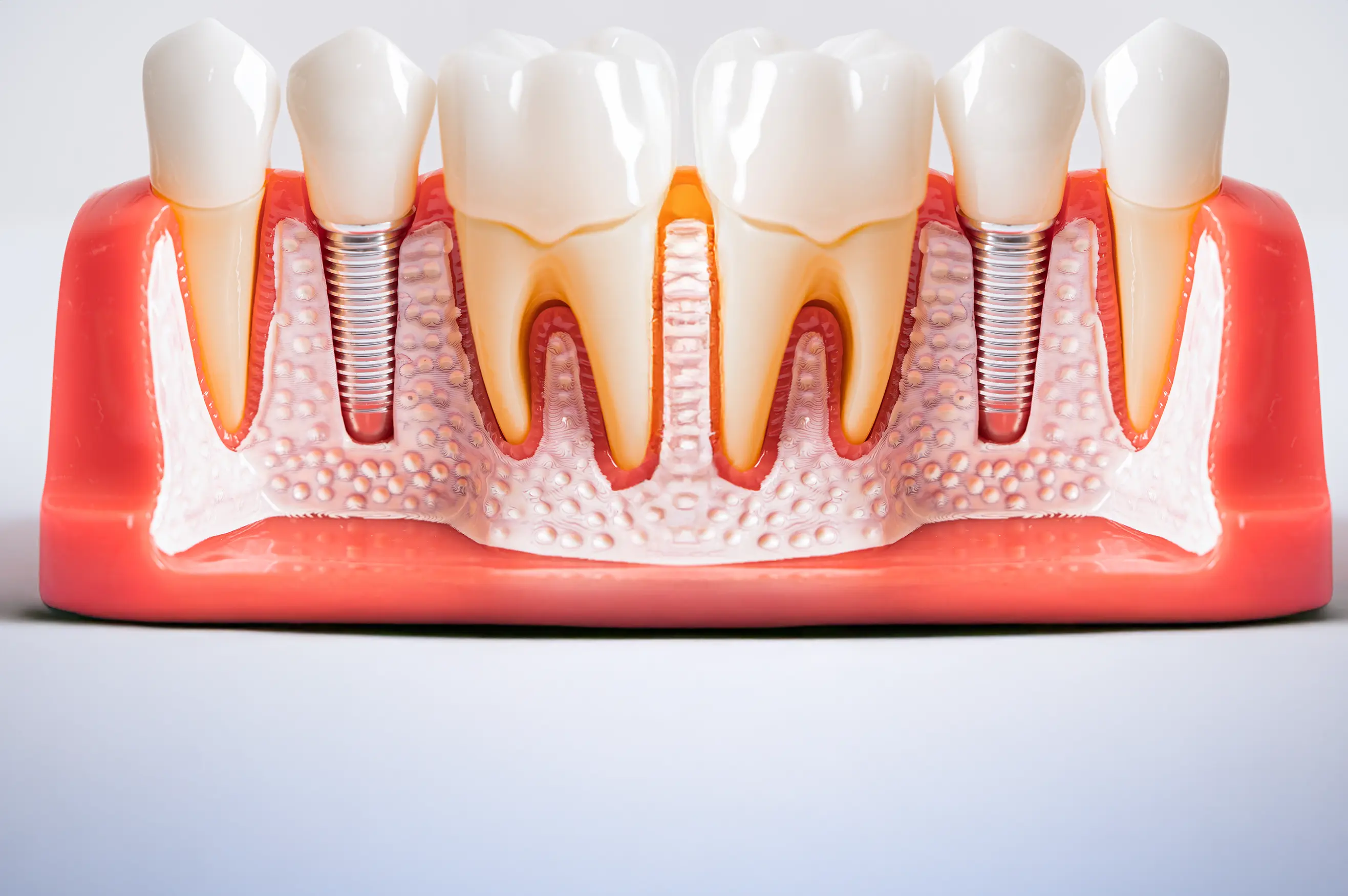Painless Dental Implants: Is It Possible and Where Can You Get It?