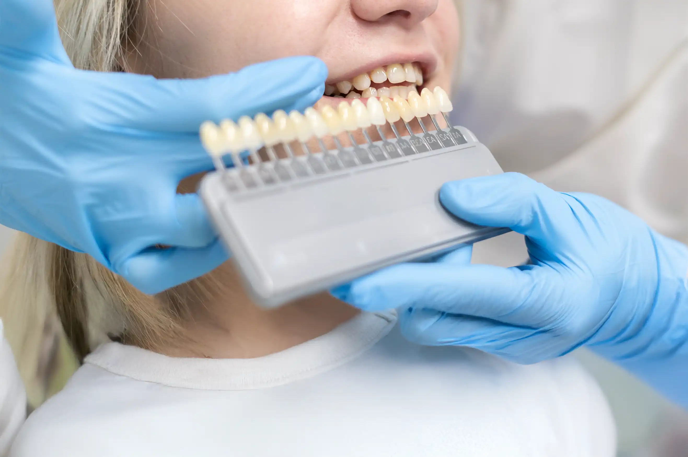 Turkey Veneers: Cost, Types, and Why They’re So Popular for the Perfect Smile