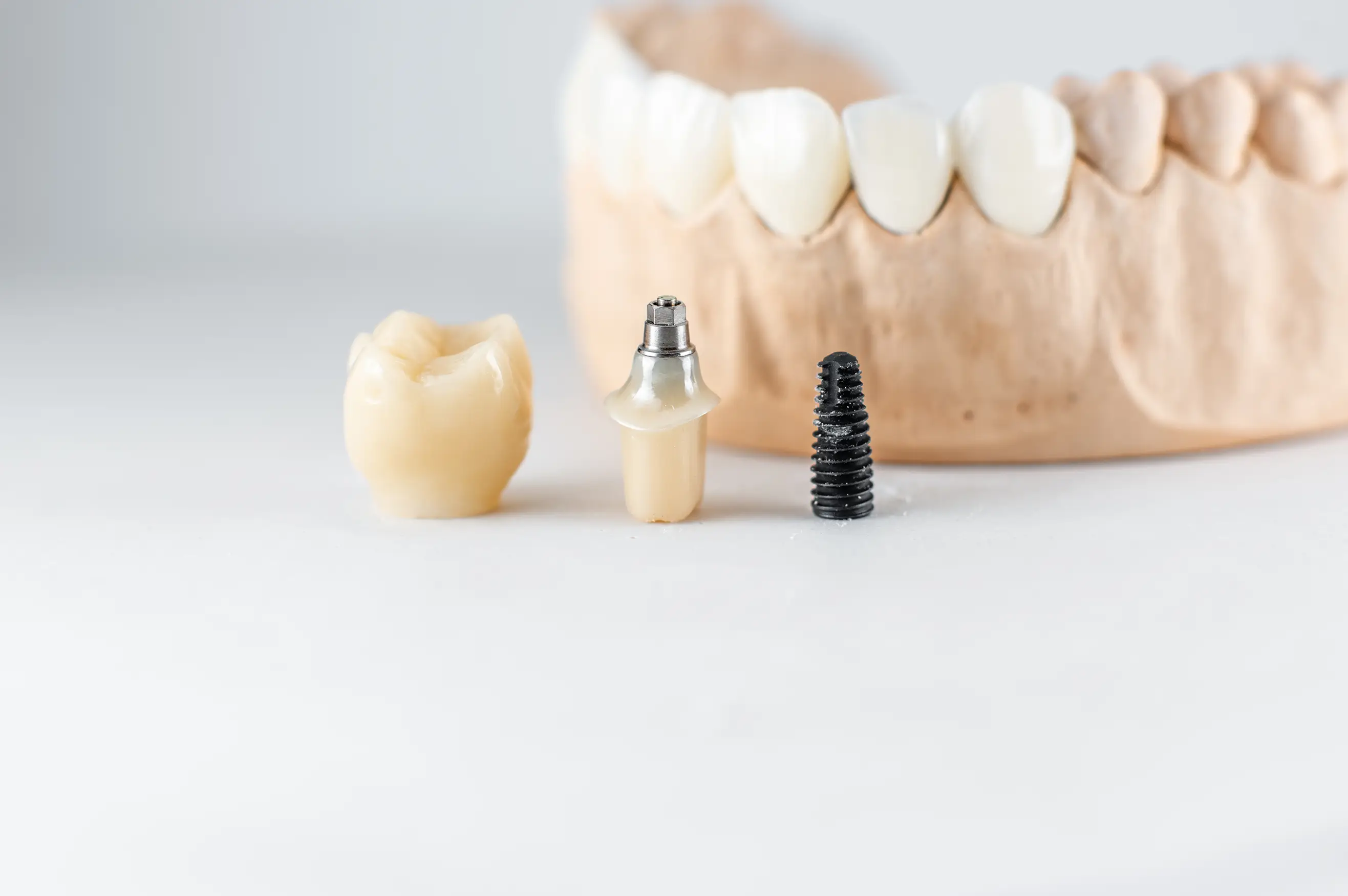 Tooth Replacement After Extraction: Best Options, Costs in Turkey & Healing Tips | Background Image