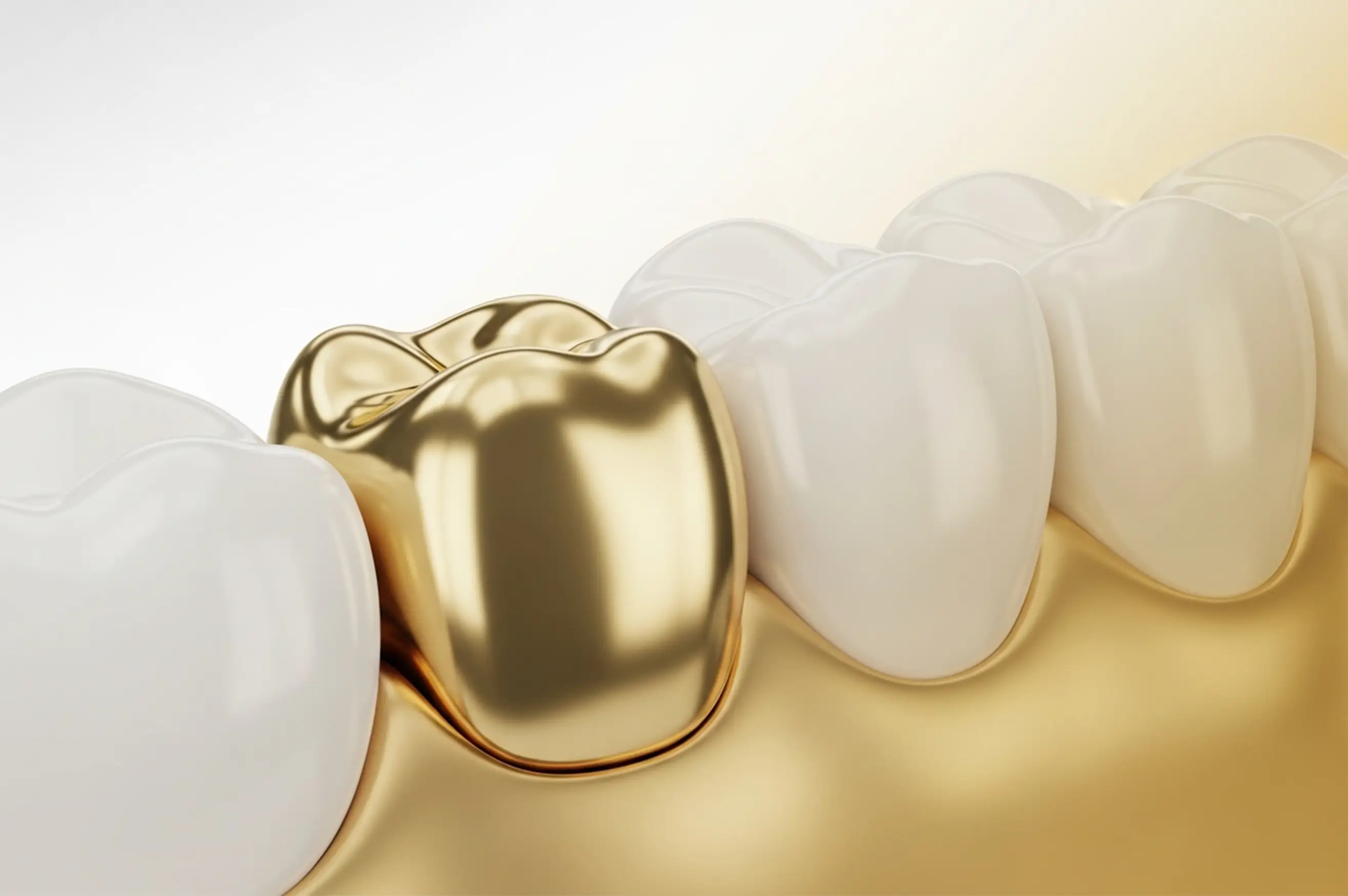 Gold Dental Crowns: Cost, Benefits, and Disadvantages | Gold Teeth & Crowns in Turkey | Background Image Gold Dental Crowns: Cost, Benefits, and Disadvantages | Gold Teeth & Crowns in Turkey | Background Image