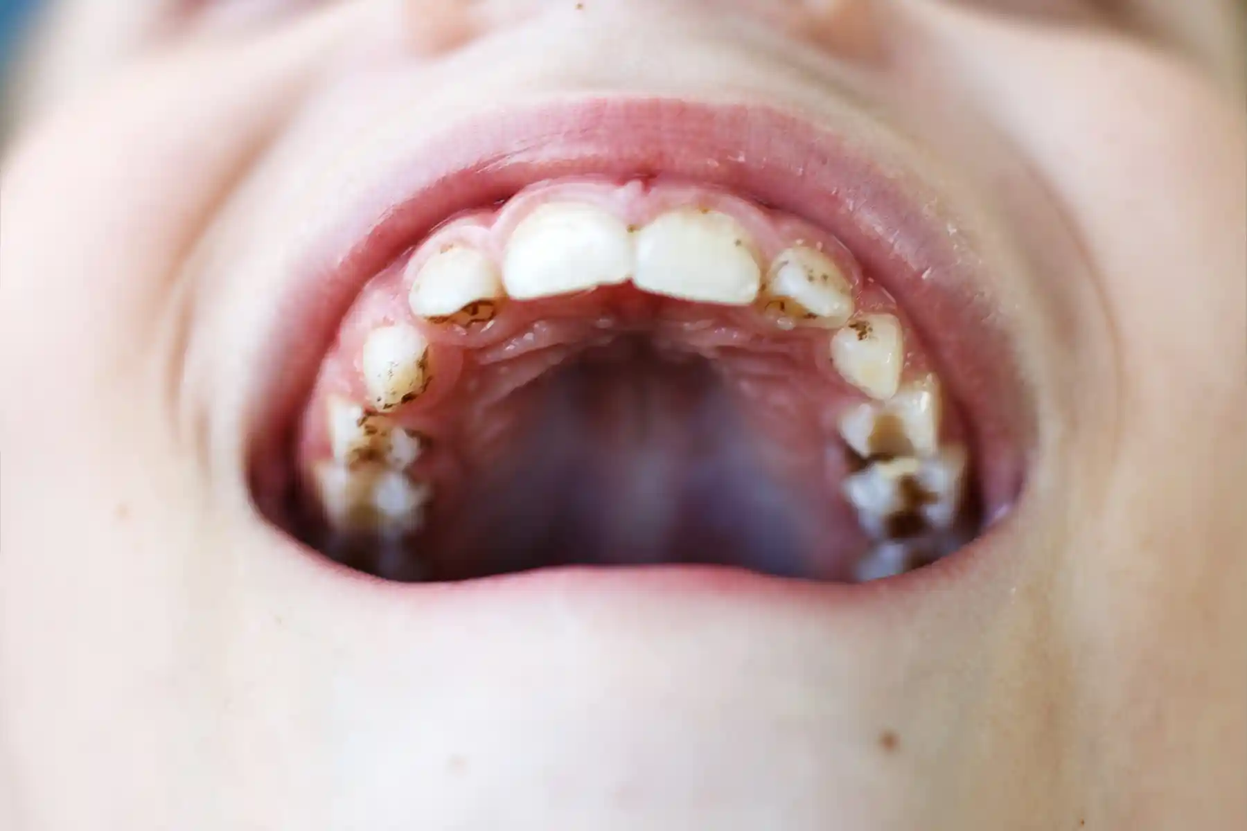 Tooth Decay Treatment: Causes, Symptoms, Stages, and Prevention Explained by Dental Experts