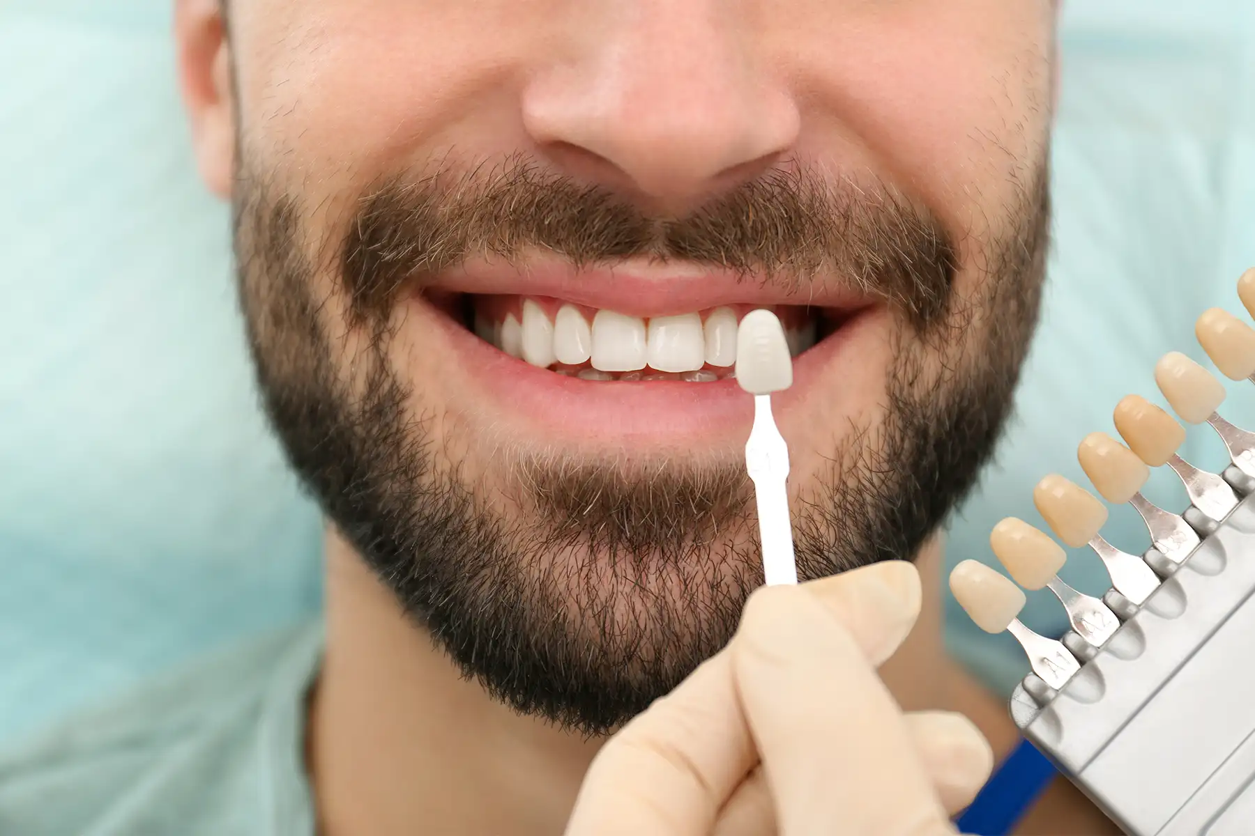 I diabetici possono mettere le faccette? Tutto ciò che devi sapere prima del trattamento